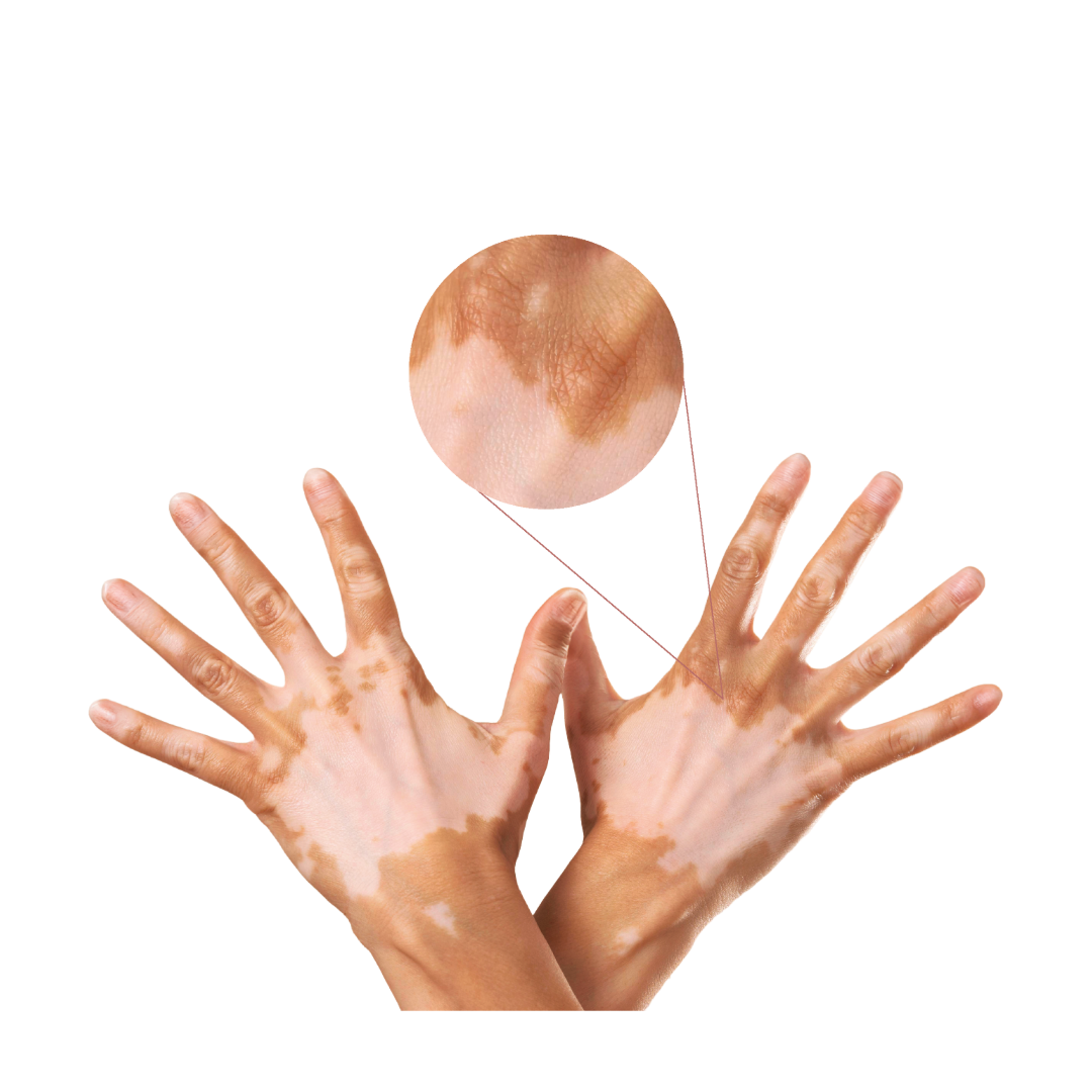 البهاق (Vitiligo)