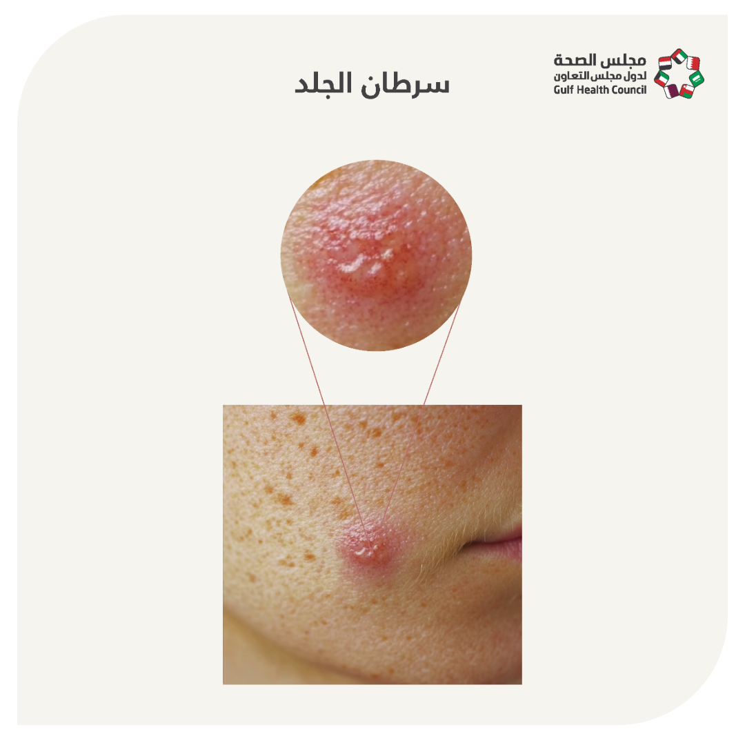 سرطان الجلد  (Skin Cancer)