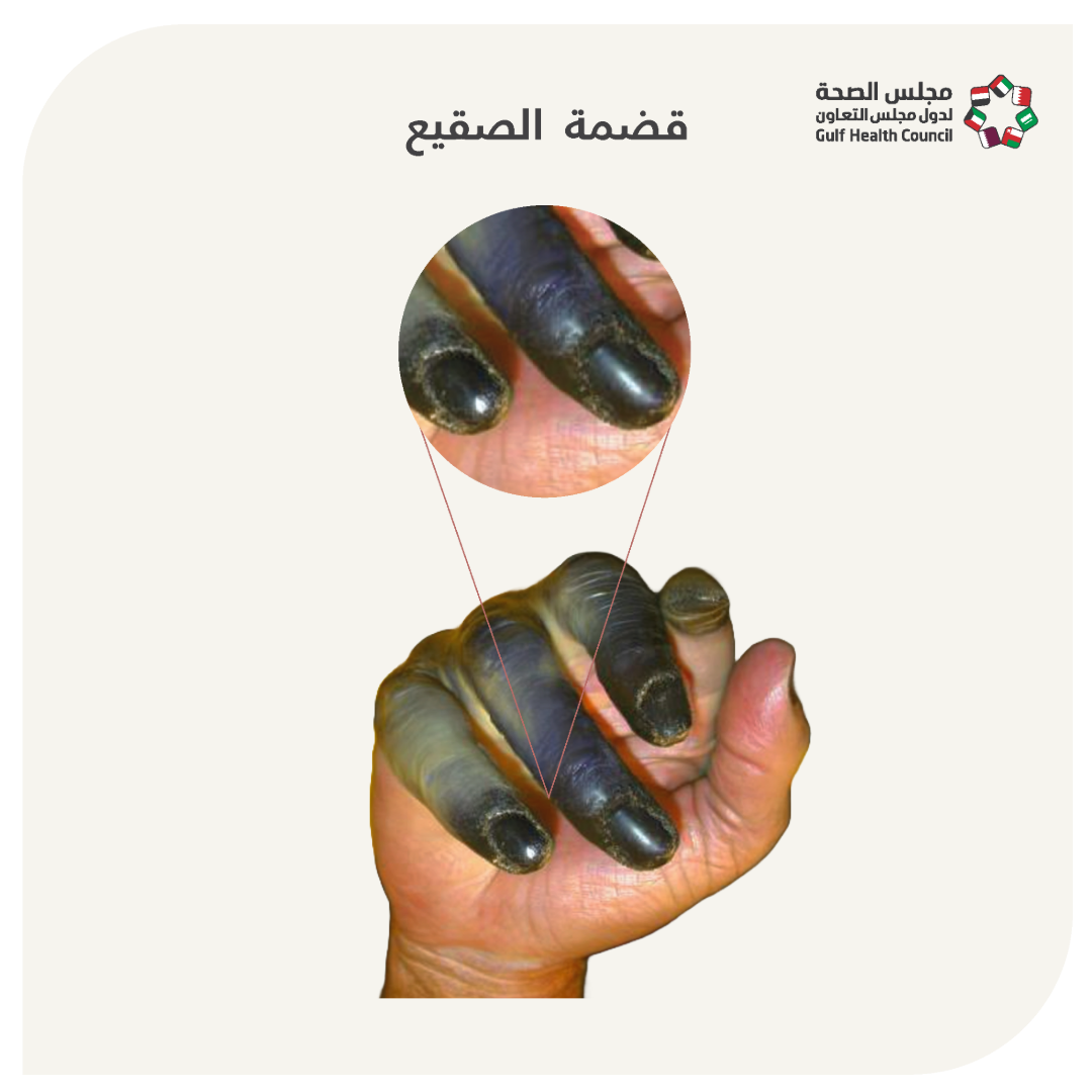 قضمة الصقيع  (Frostbite)