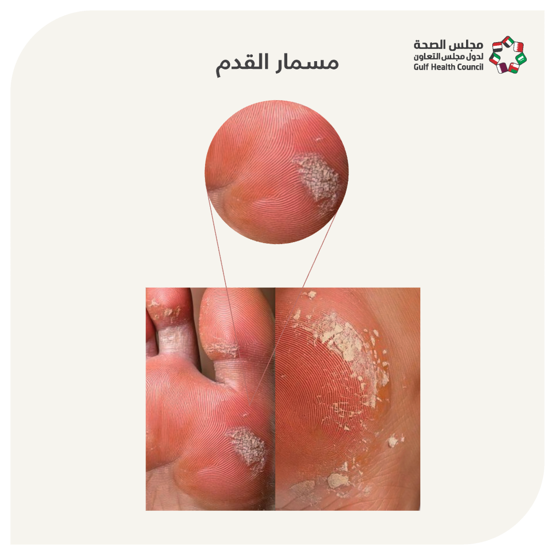 مسمار القدم (Corns and Calluses)