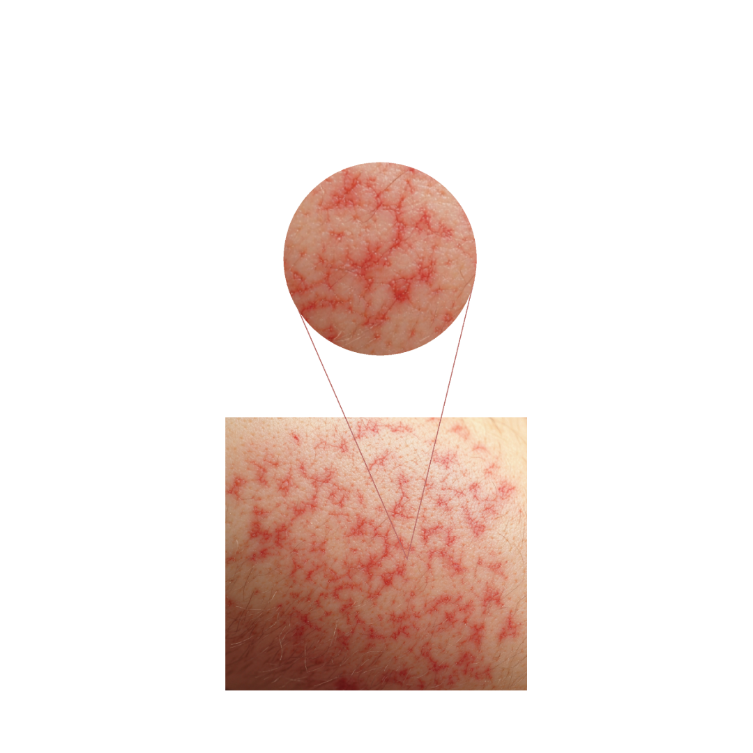 الطفح الجلدي  (Skin Rash)