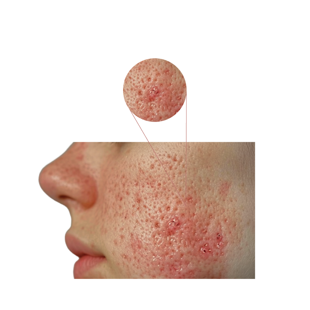 حب الشباب  (Acne)
