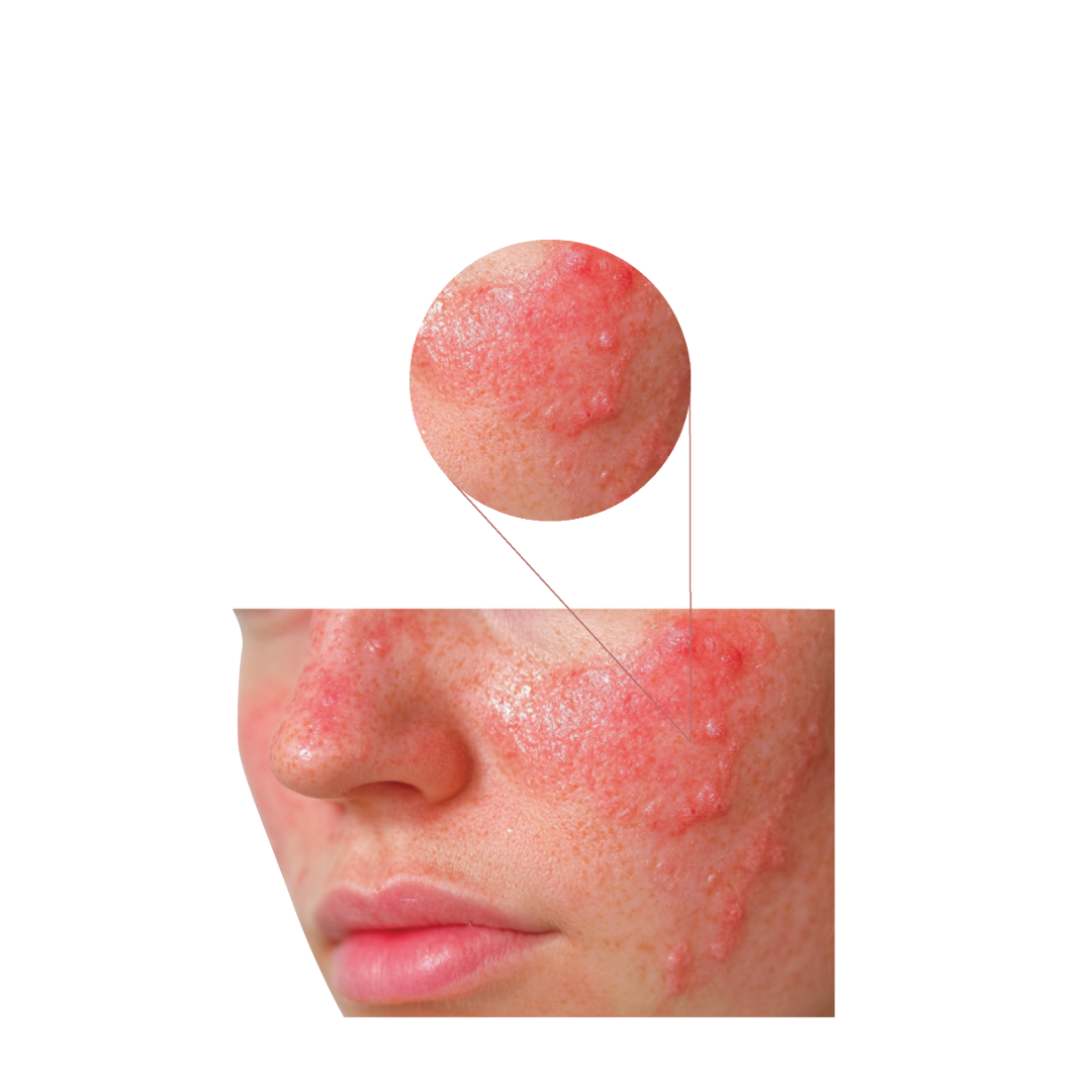 العد الوردي (الوردية) (Rosacea)