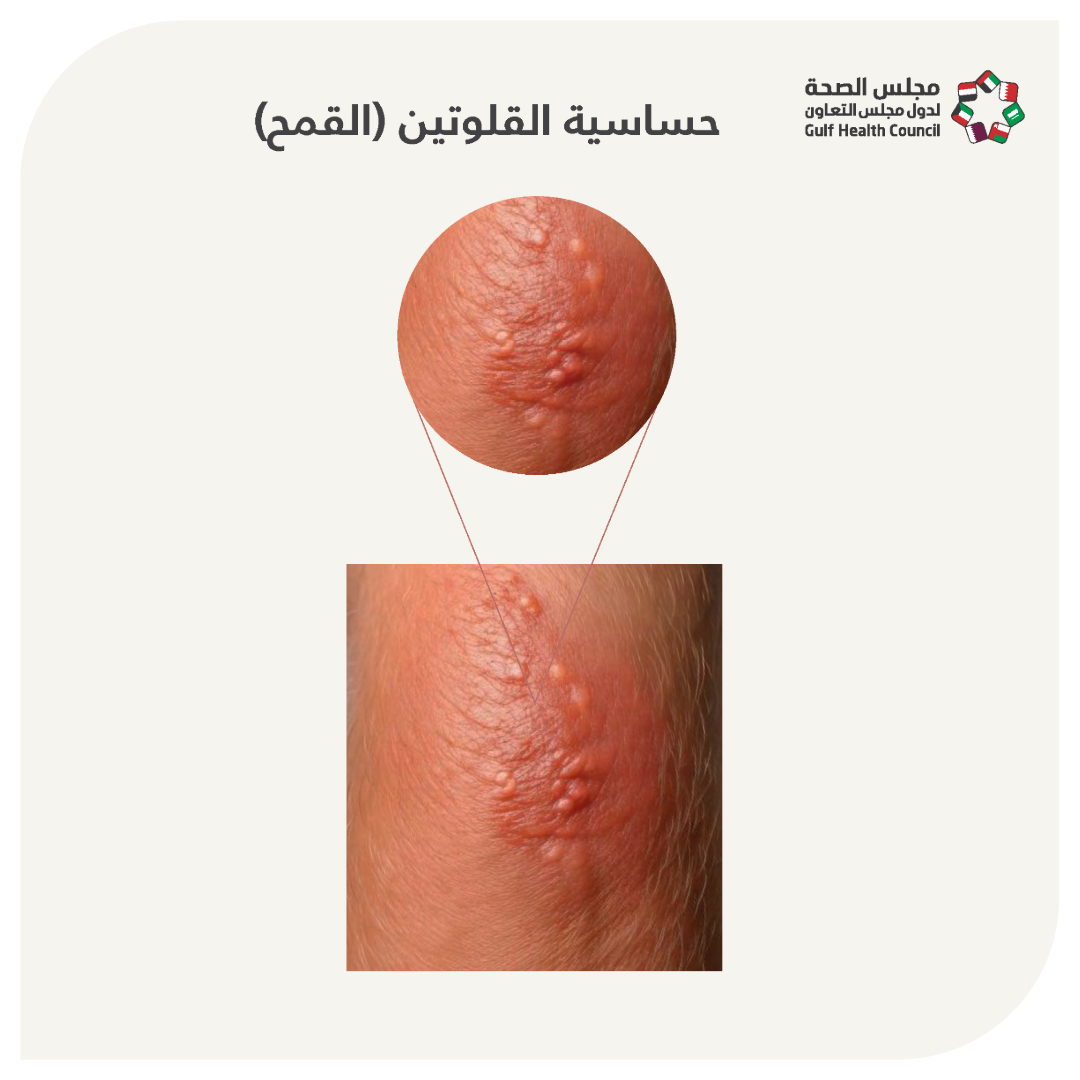 حساسية القمح (Wheat Allergy)