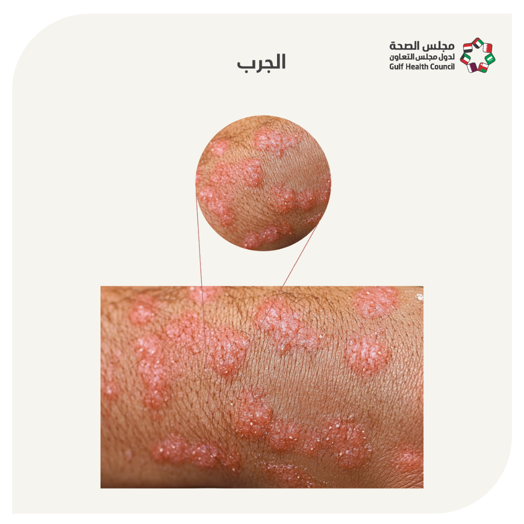 الجرب (scabies)