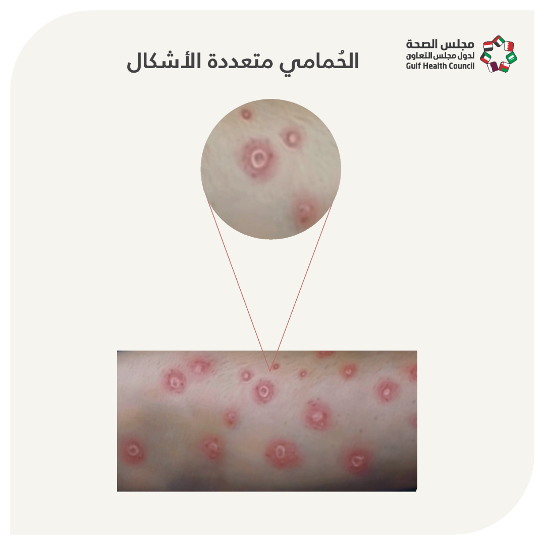 الحمامي عديدة الأشكال (Erythema multiforme)