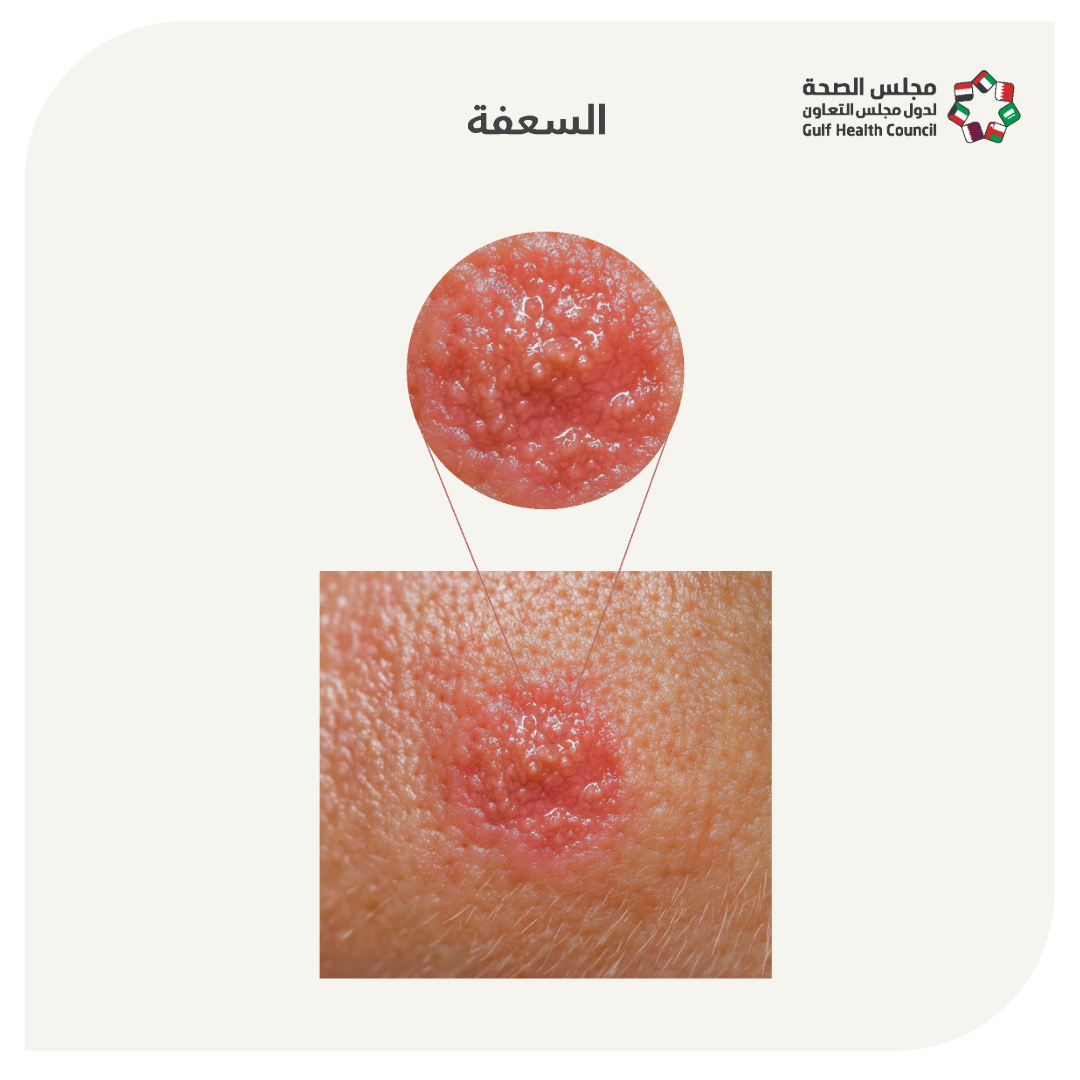 سعفة الرأس (Tinea capitis)
